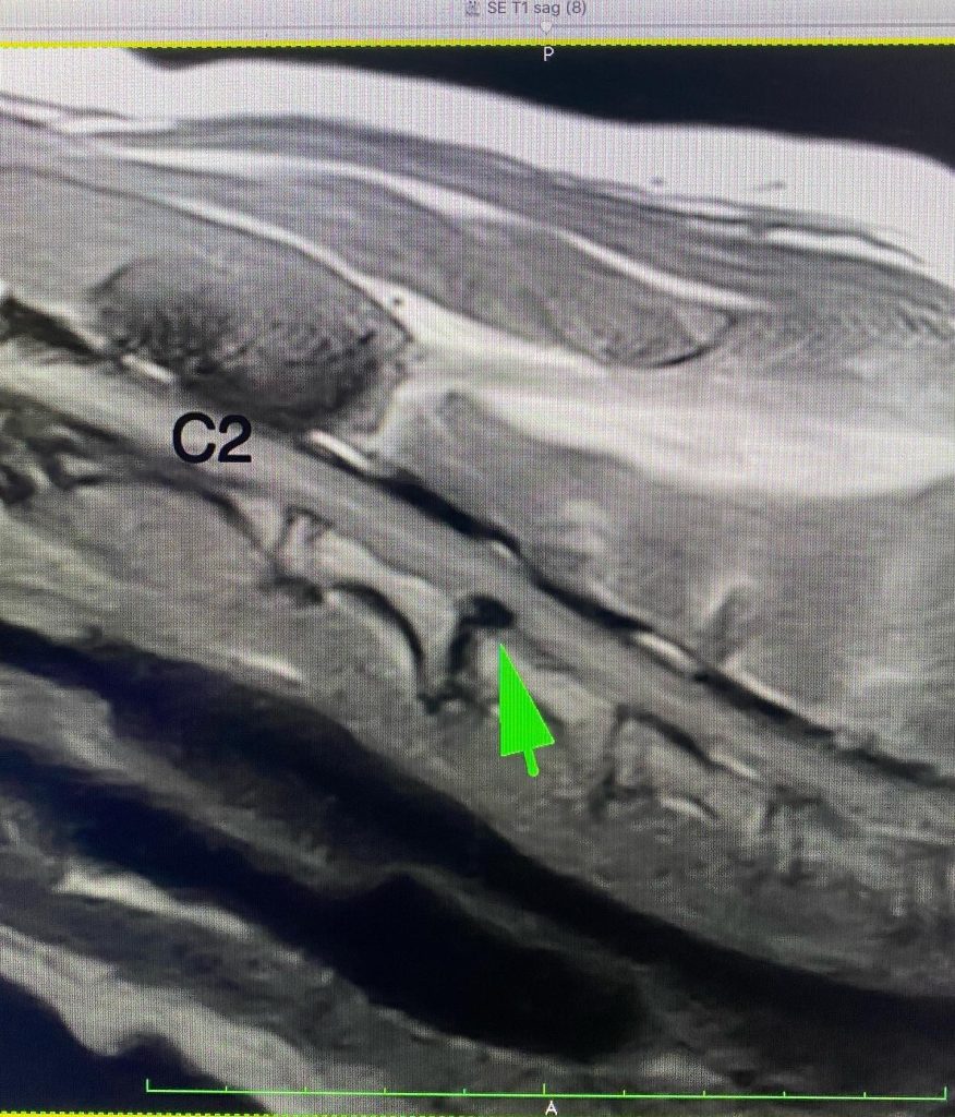 IVDD, intervertebral disc extrusion, herniation, canine, transverse