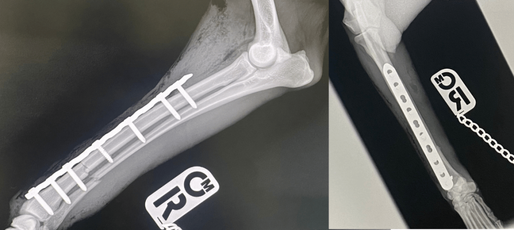 Ulna and Radis surgery